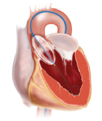 Mercy Angiography > Procedures & Treatments > Interventional Cardiology ...