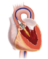 Mercy Angiography > Procedures & Treatments > Interventional Cardiology ...