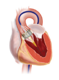 Intra > Procedures and treatments > Interventional cardiology ...